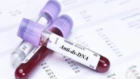 آزمایش آنتی بادی ضد DNA