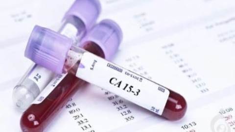آزمایش تومور مارکر CA15-3 (آنتی ژن سرطان 3-15)