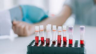 آزمایش خون برای پیش بینی سرطان سینه