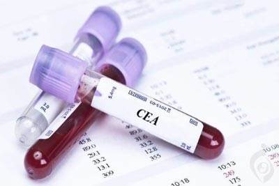 آزمایش آنتی ژن کارسینوامبریونیک (CEA)