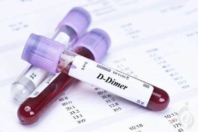 آزمایش دی-دایمر ، محصول تجزیه فیبرین (FDP)