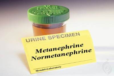 آزمایش متانفرین و نورمتانفرین ادرار (MN , NM)