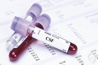آنالیز و کشت مایع مغزی نخاعی (CSF)