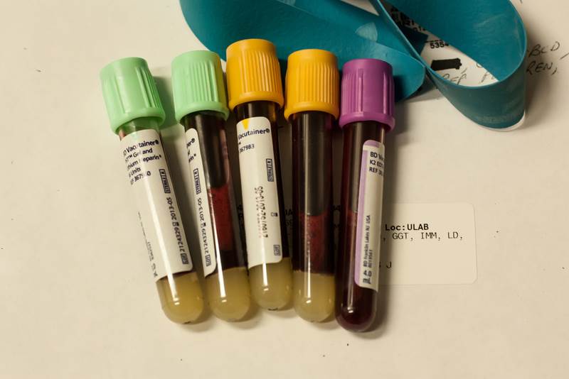 آزمایش خون در محل