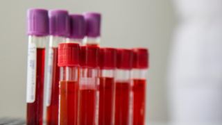 آیا آزمایش خون خطر مرگ با کرونا را تشخیص می دهد؟