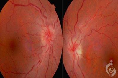 نوروپاتی چشمی ارثی لبر