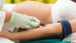 آزمایش خون برای تشخیص سندروم داون در بارداری و شرایط انجام آن