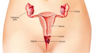 سرطان واژن چیست؟ چه علائمی دارد ؟