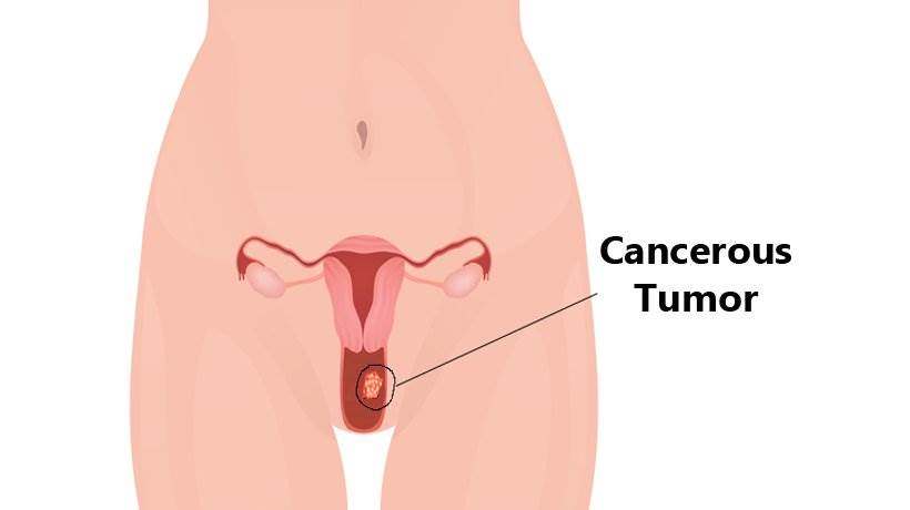 سرطان واژن چیست