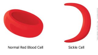 کم خونی داسی شکل چیست و علائم آن چگونه است؟