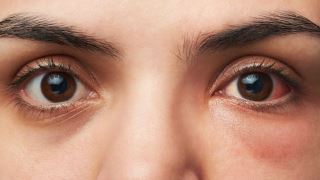 COVID-19 و چشم های دردناک - ابتلا به ویروس کرونا و احساس درد در چشم