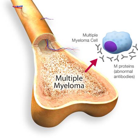ویروس کرونا و سرطان مولتیپل میلوما