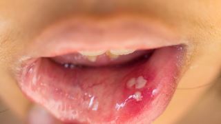 از ویروس اچ پی وی (HPV) در دهان چه می دانید؟