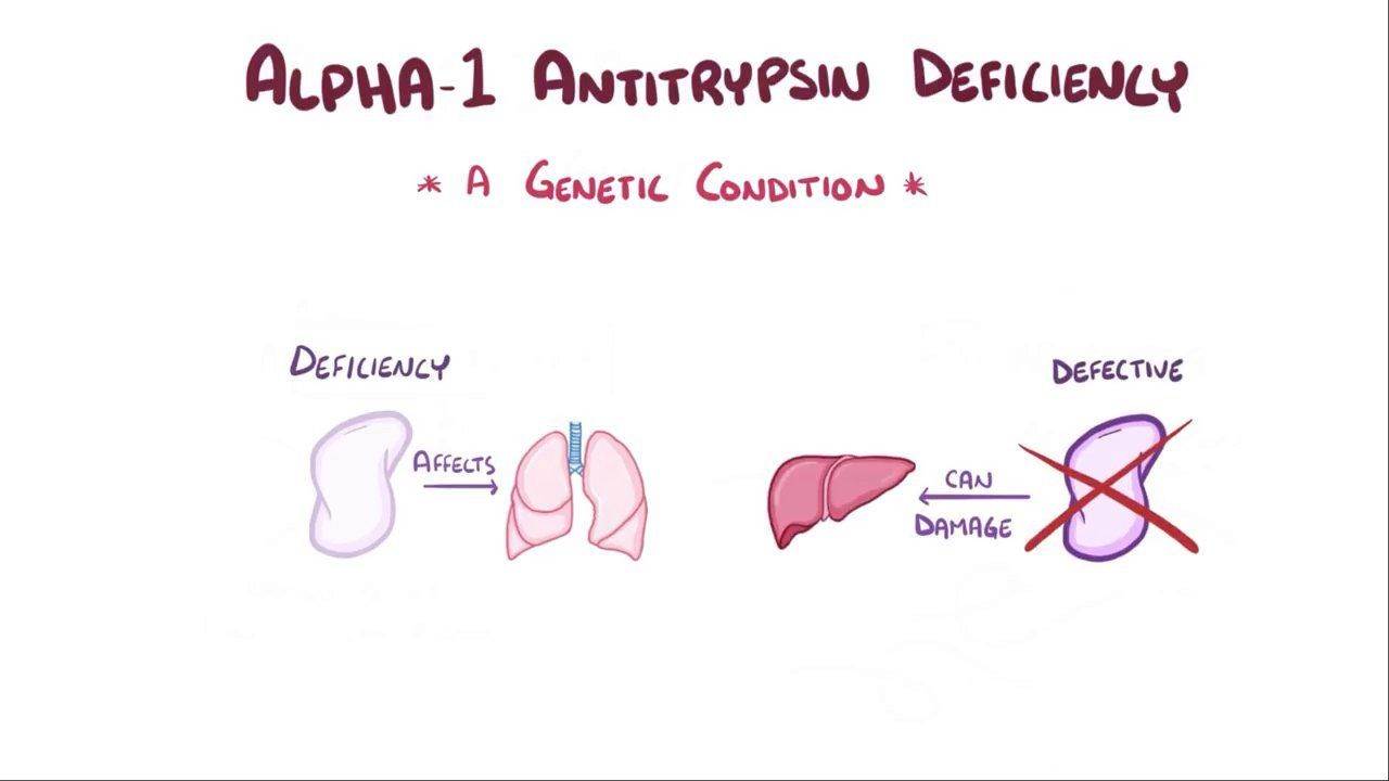 کمبود آنتی تریپسین آلفا-1 