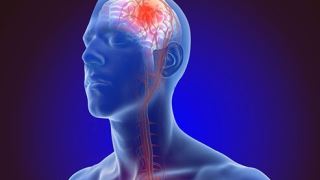از اثرات فیزیکی سکته مغزی چه می دانید؟