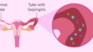 سالپنژیت چیست و چگونه درمان می شود؟