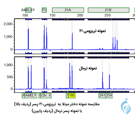 مقایسه دو نمونه QFPCR بین جنین مبتلا و جنین سالم