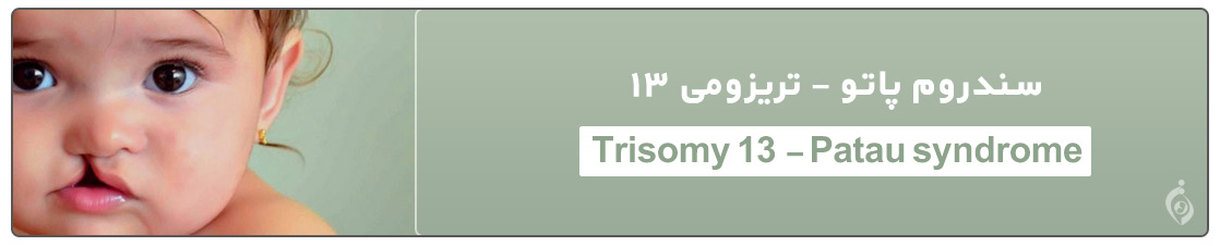 تریزومی 13 - سندروم پاتو