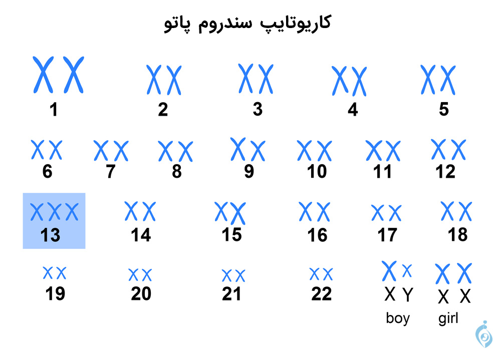 تصویر کاریوتایپ بیمار مبتلا به سندروم پاتو