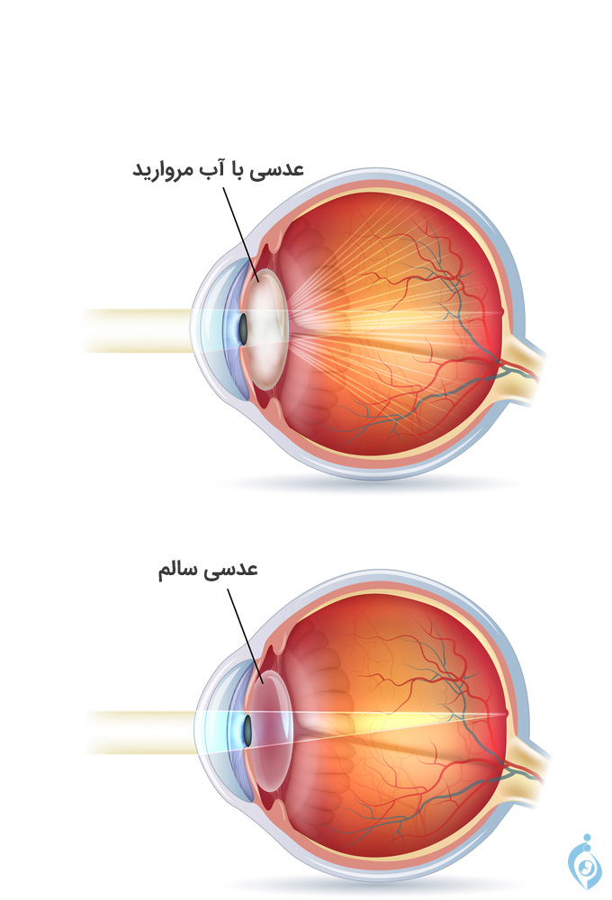 عدسی آب مروارید