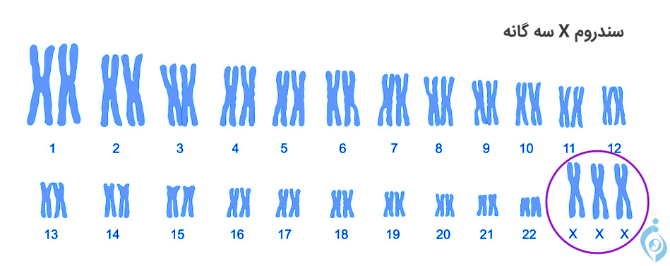 کاریوتایپ تریزومی ایکس سه گانه