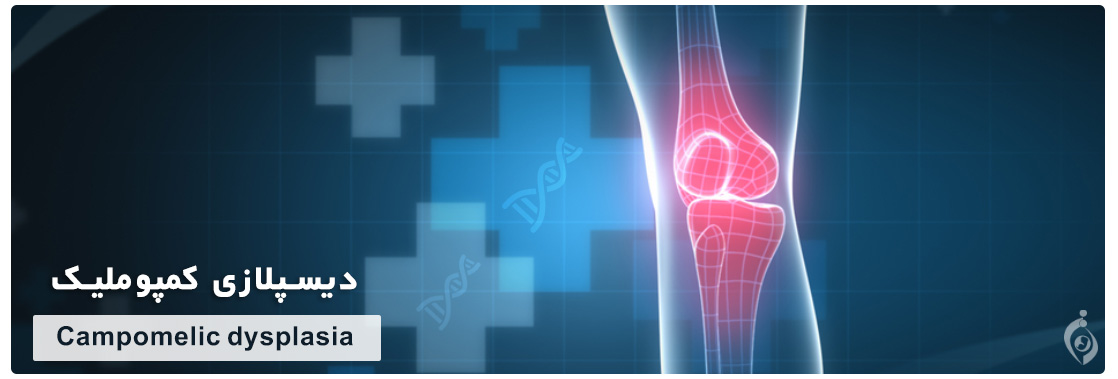 Campomelic dysplasia