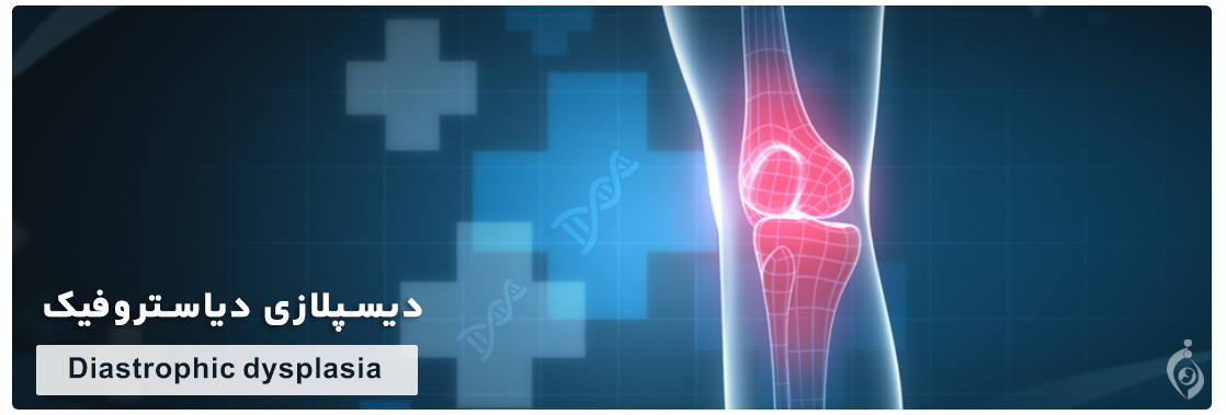 Diastrophic dysplasia