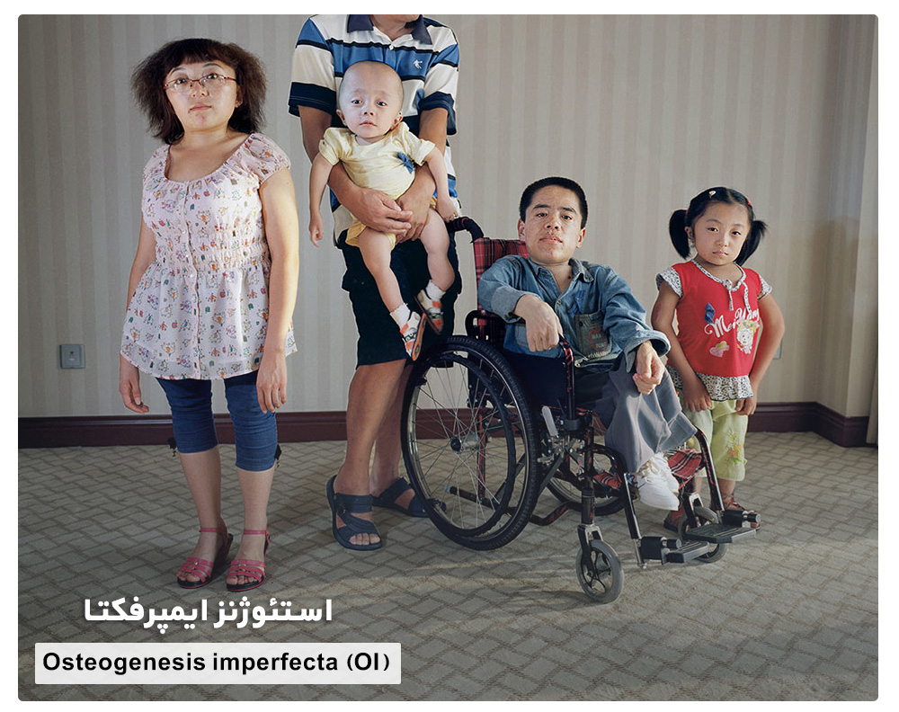 Osteogenesis imperfecta