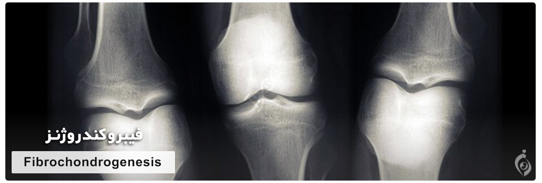 Fibrochondrogenesis