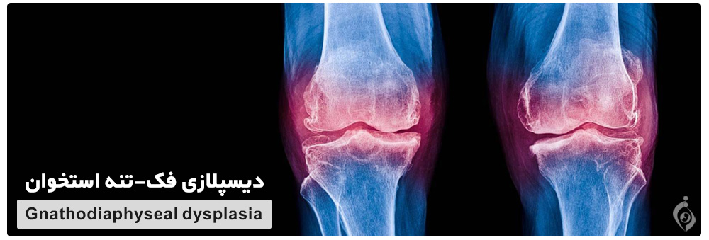 Gnathodiaphyseal dysplasia