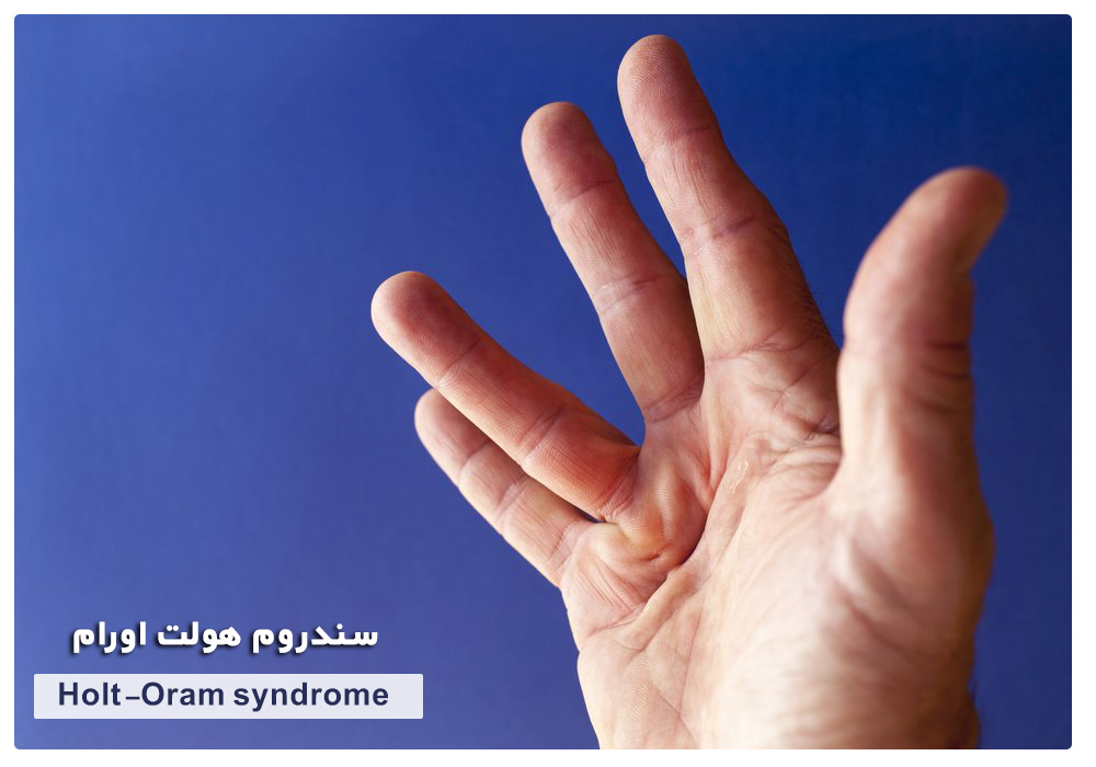 Holt-Oram syndrome