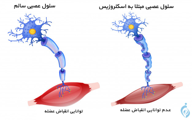 سلول عصبی فرد مبتلا به اسکلروزیس