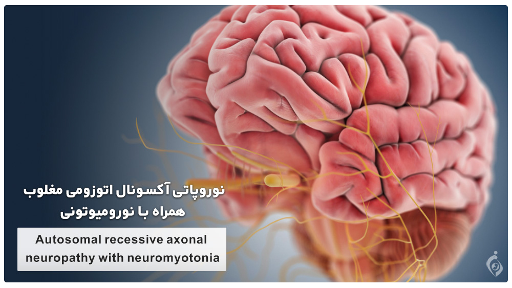 نوروپاتی آکسونال اتوزومی مغلوب همراه با نورومیوتونی