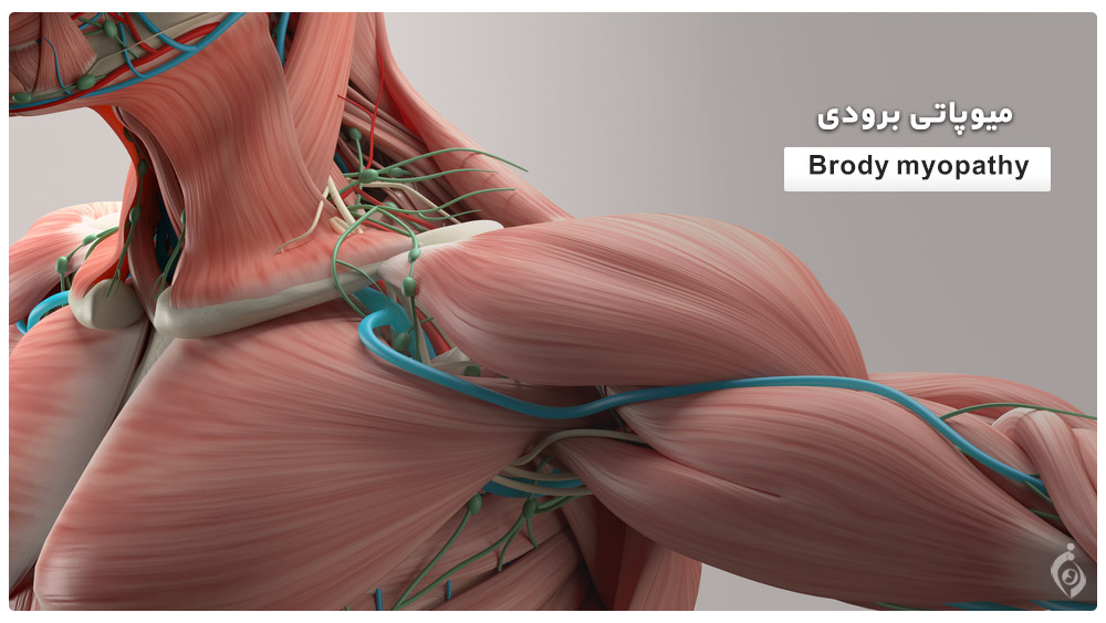 Brody myopathy