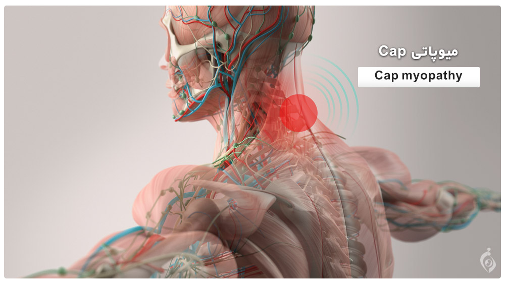 Cap myopathy