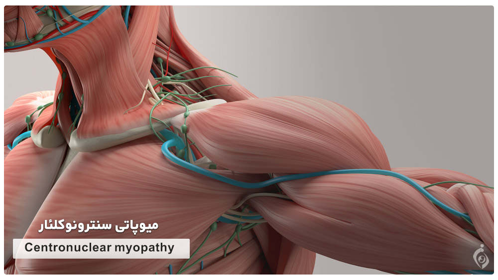 Centronuclear myopathy