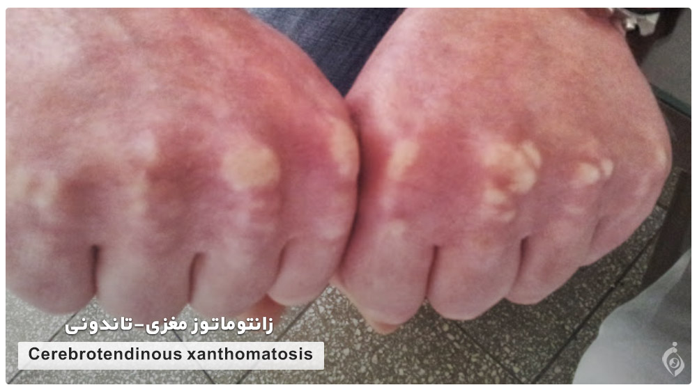 Cerebrotendinous xanthomatosis