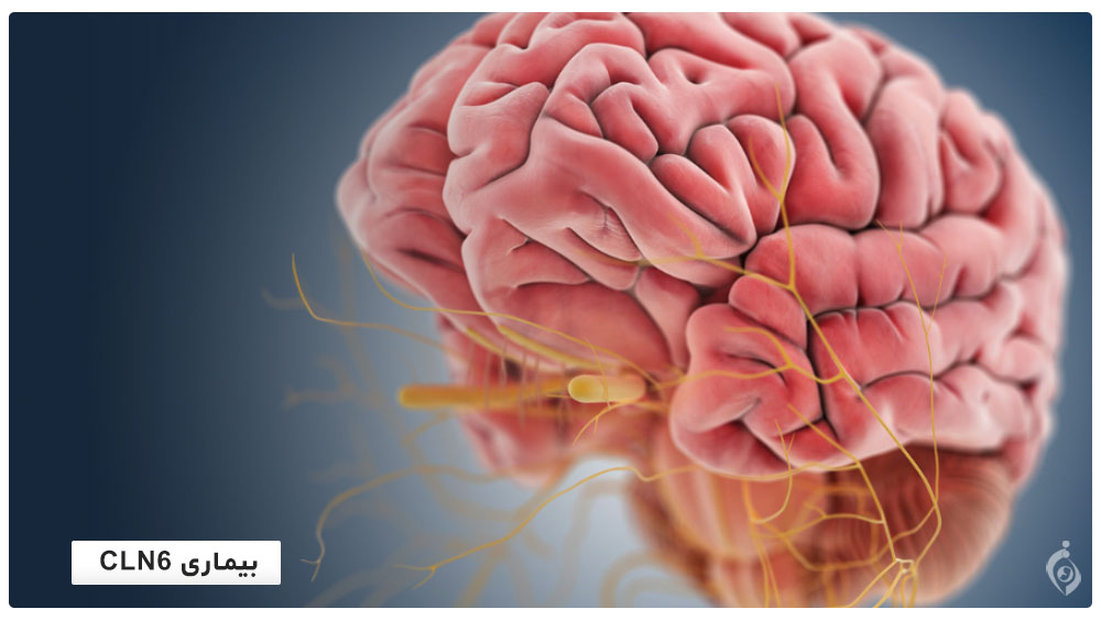 بیماری CLN6