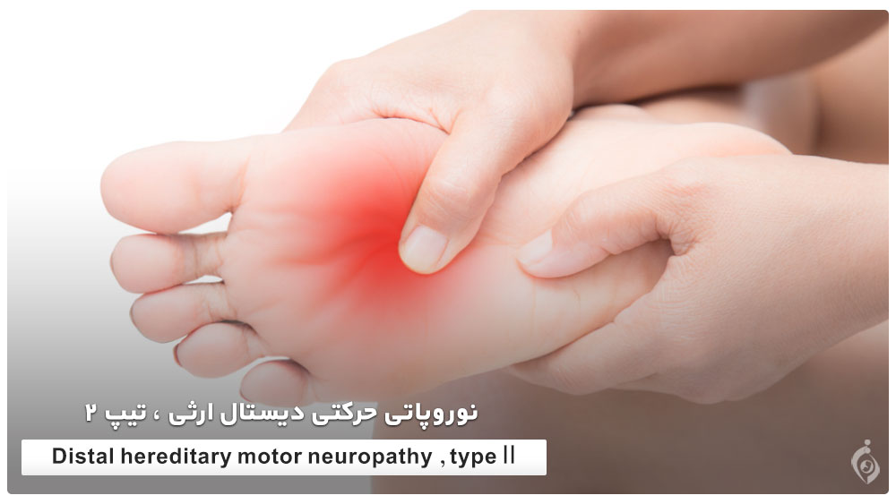  Distal hereditary motor neuropathy , type 2