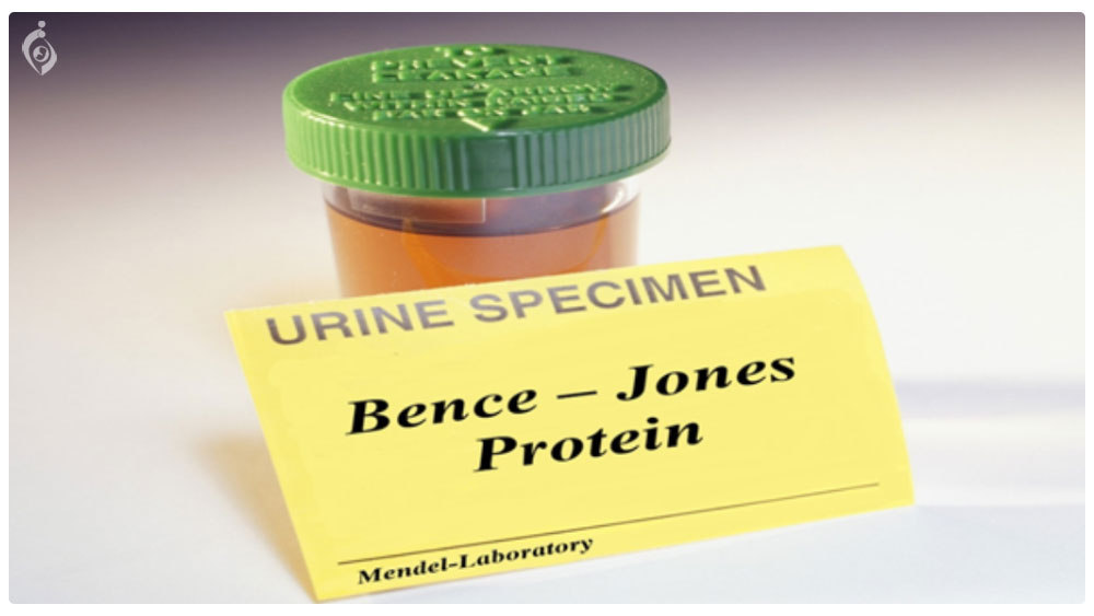 آزمایش پروتئین بنس – جونز