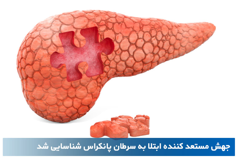 سرطان پانکراس