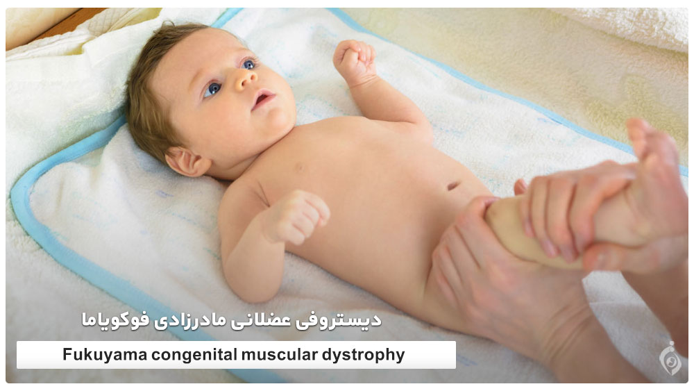 Fukuyama congenital muscular dystrophy