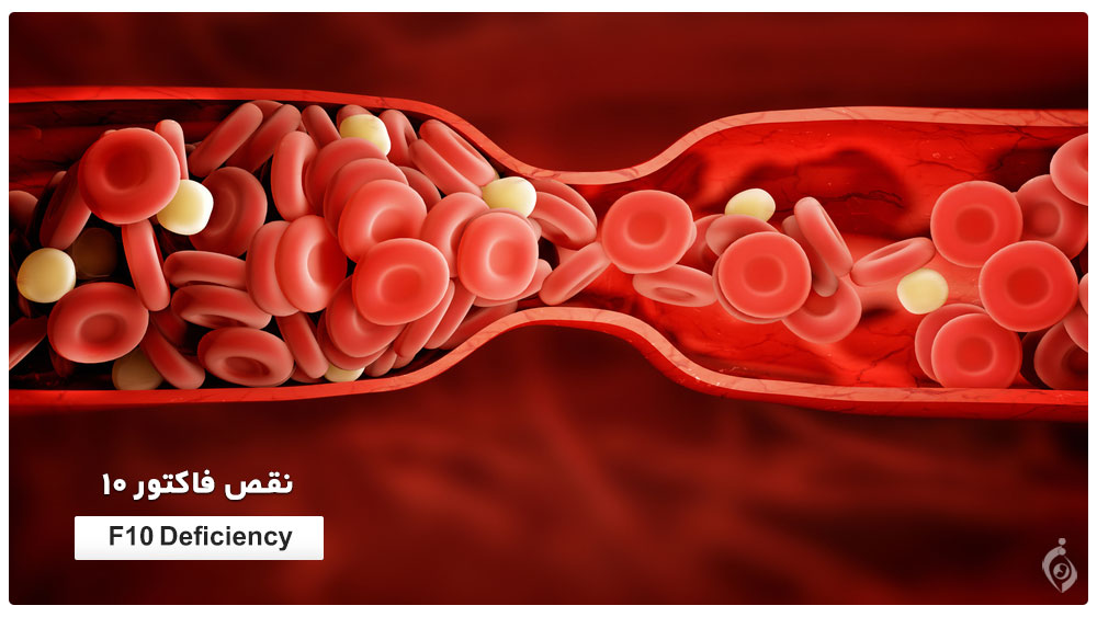 نقص فاکتور ١٠