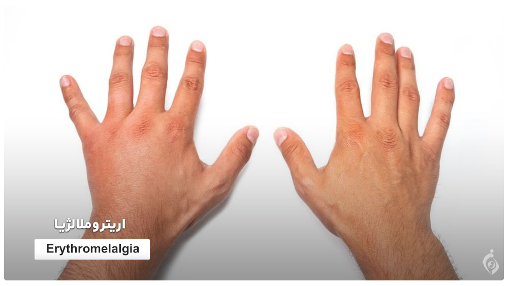 Erythromelalgia