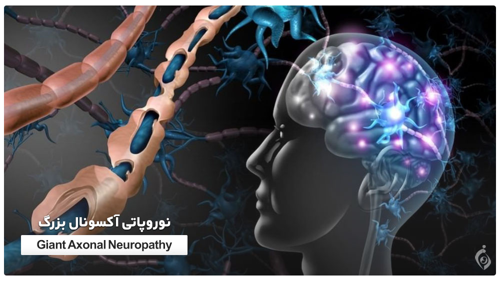 نوروپاتی آکسونال بزرگ