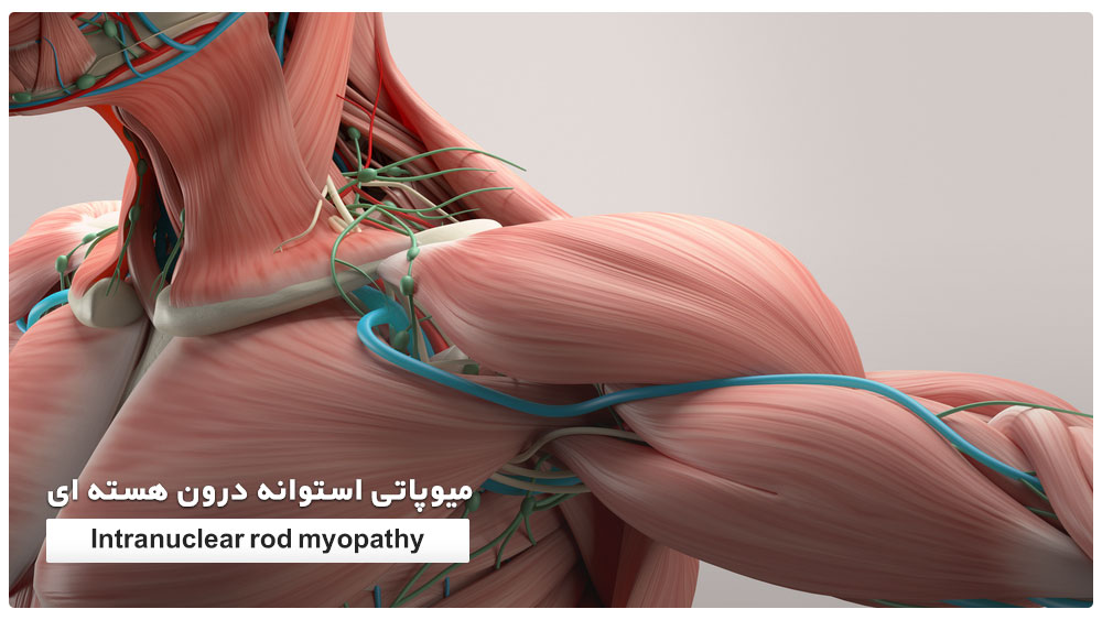 میوپاتی استوانه درون هسته ای