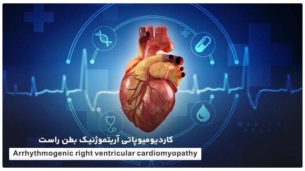 کاردیومیوپاتی آریتموژنیک بطن راست