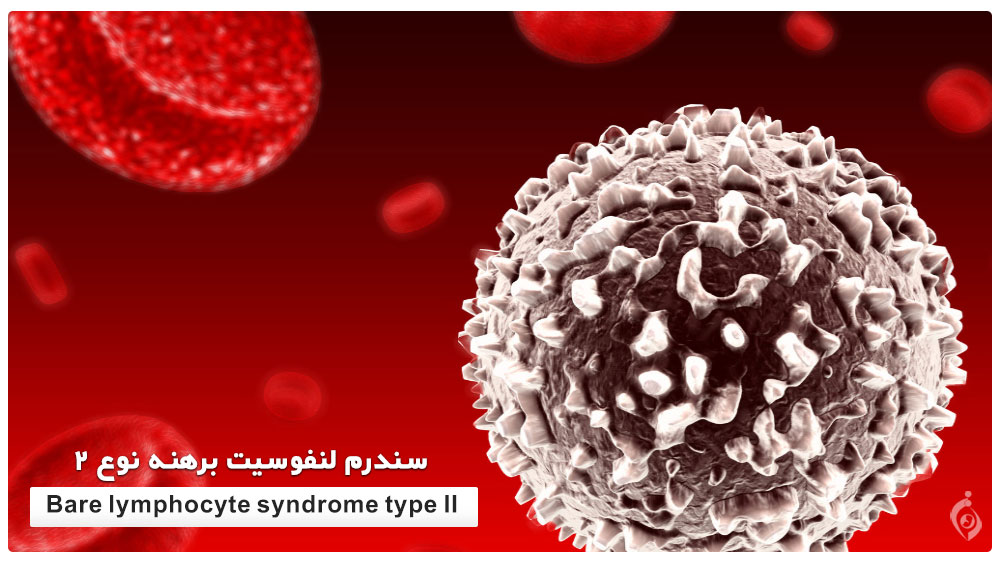 Bare lymphocyte syndrome type II