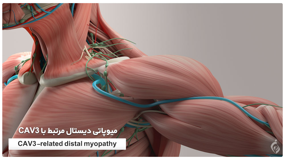 میوپاتی دیستال مرتبط با CAV3