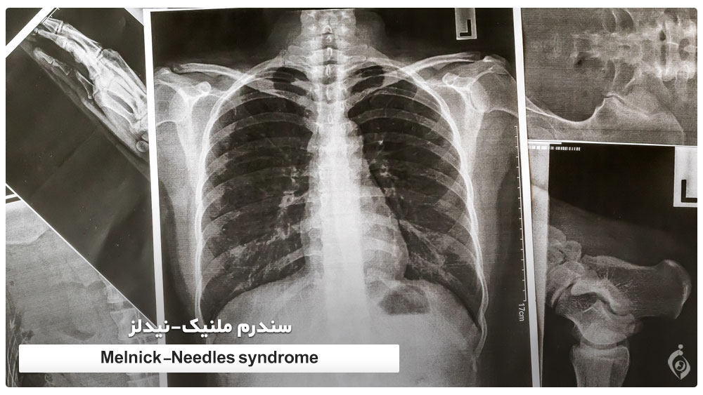 Melnick-Needles syndrome